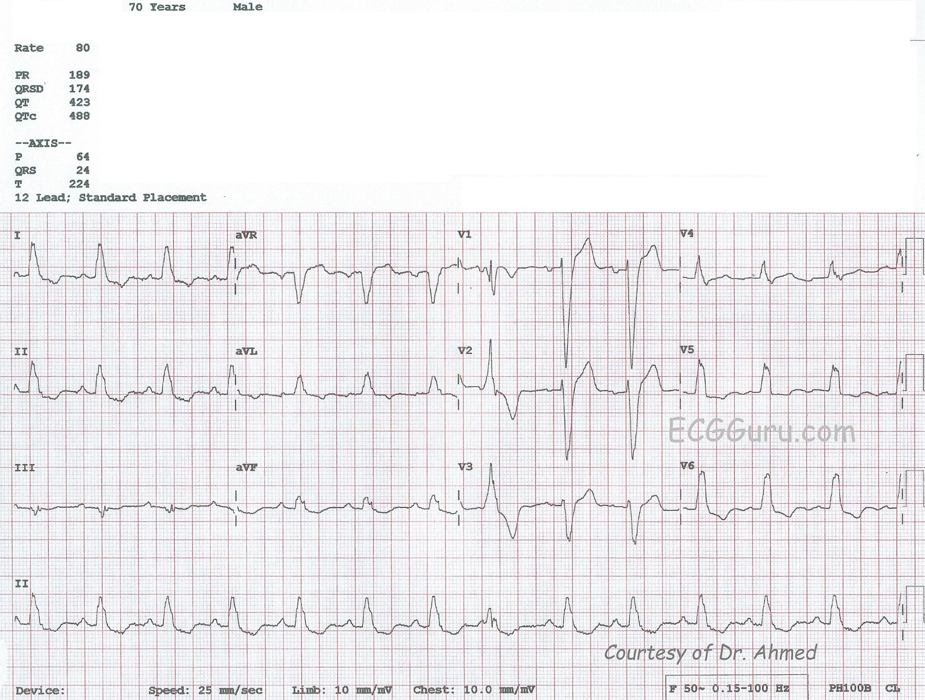 Complete Left Bundle Branch Block